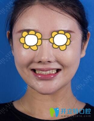 做牙貼面美白前