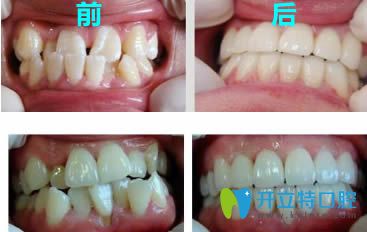 河源拜博周偉安醫(yī)生牙齒矯正前后對(duì)比案例