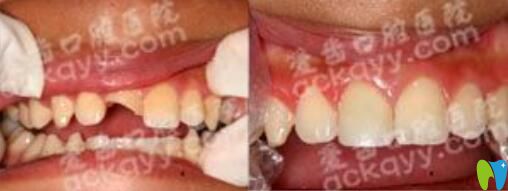 曾華醫(yī)生美容樹脂充填牙齒缺損案例