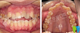 濰坊華貝口腔周文棟牙齒矯正前照片