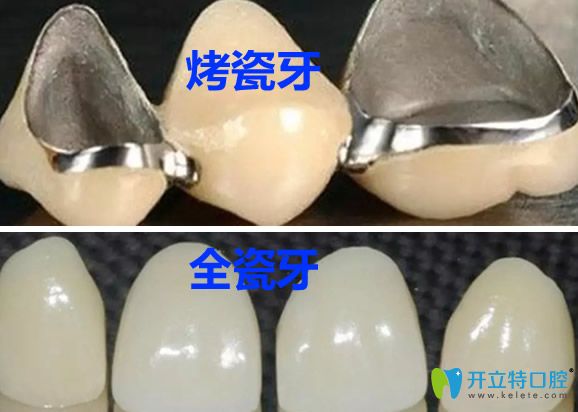 全瓷牙和烤瓷牙所用材料不同