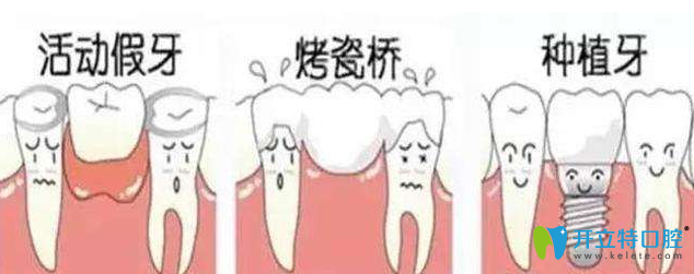 現(xiàn)在都是種植牙了