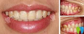 華貝口腔周文棟醫(yī)生牙齒矯正后效果圖