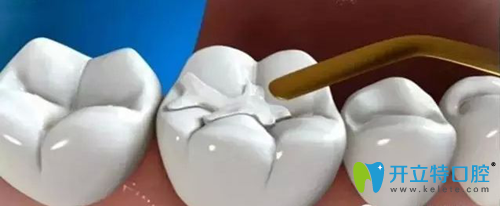 補(bǔ)牙多少錢 補(bǔ)牙多少錢