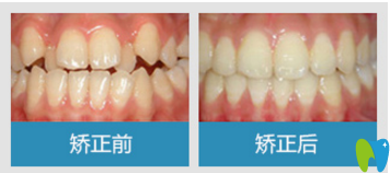 牙齒矯正前后對比