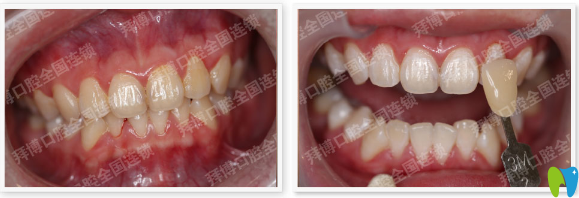 佛山拜博口腔牙齒美學修復案例