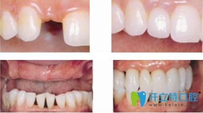 萬翔口腔單顆和多顆牙種植效果案例 萬翔口腔單顆和多顆牙種植效果案例