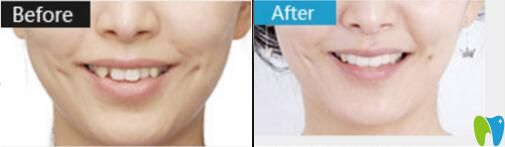 烏魯木齊美奧口腔張翔牙齒矯正真人案例前后對比圖