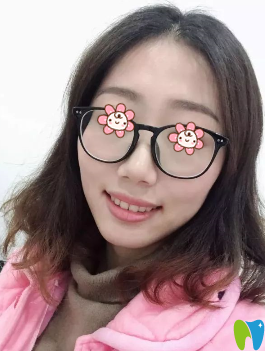 沈陽愛齒口腔齙牙矯正兩年后效果