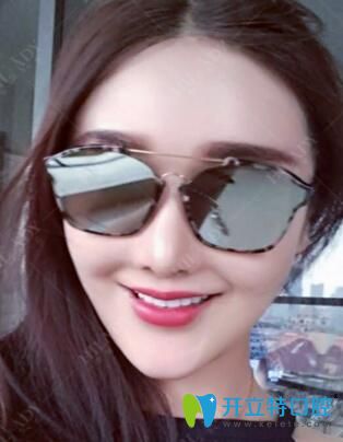 在華領(lǐng)口腔做超薄牙貼面2個月效果