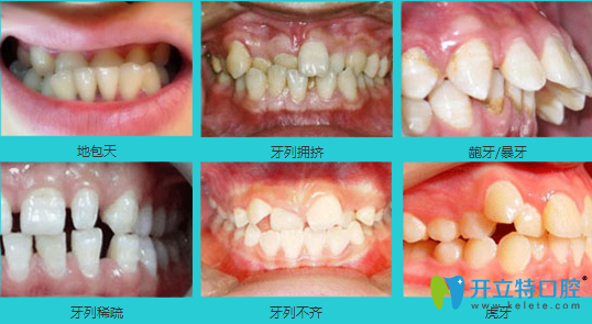 需要矯治的牙齒類型