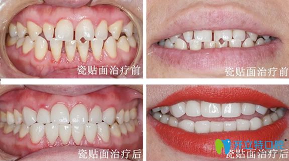 遵義華美口腔3D牙齒貼面治療前后對(duì)比照片