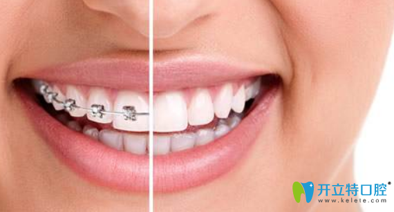 遵義華美口腔嬴胡川揭秘：成人矯正牙齒的后遺癥有哪些？