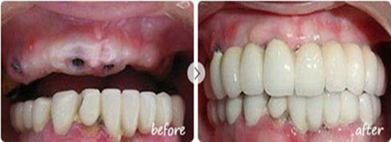 在汕頭芽芽口腔做牙缺失種植修復(fù)，是我做過(guò)較理智的選擇