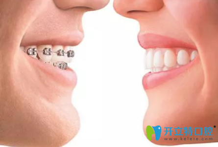 成年人做牙齒矯正