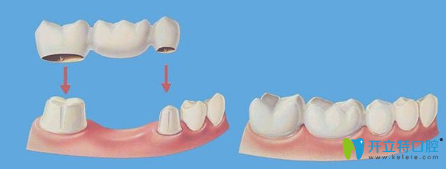 烤瓷牙的安裝過(guò)程