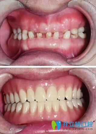 李曉莉院長牙齒咬合正畸案例 李曉莉院長牙齒咬合正畸案例