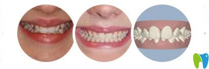 長沙美萊口腔成人牙齒矯正