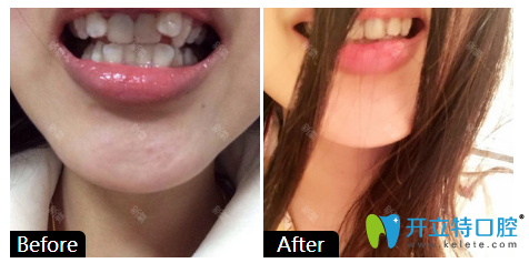 廣州柏德口腔牙齒矯正案例對(duì)比圖