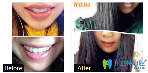 廣州柏德口腔3M金屬進(jìn)口托槽矯正牙齒案例