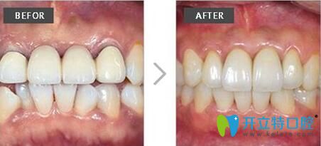 范金梅院長根管治療案例