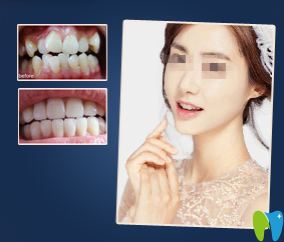 濰坊可恩口腔牙齒矯正效果圖