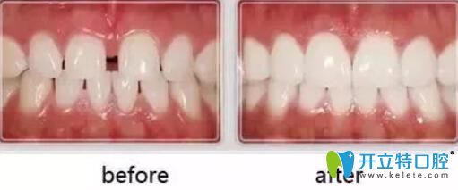 <!--<i data=20240703-sp></i>-->醫(yī)師牙齒貼面案例