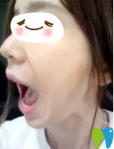 已經(jīng)三個(gè)月了我可以大張嘴了