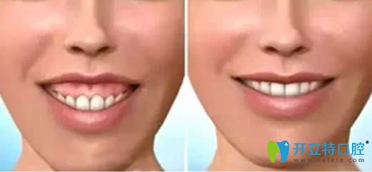 隱形矯正可以改變臉型么