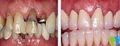 濰坊可恩口腔亓慶國根管治療效果圖