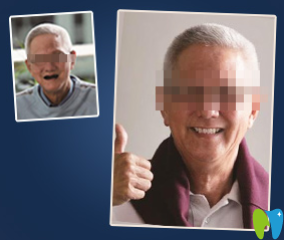 濰坊可恩口腔姜桂波種植牙效果對(duì)比圖