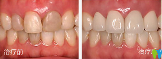 吸煙導致牙齒發(fā)黃？菏澤美爾口腔全瓷牙修復就能幫你改善