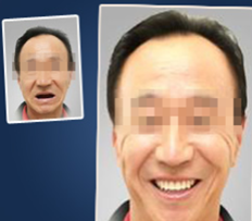 真人案例：廈門宏沅膛口腔60歲老人種植牙術(shù)前術(shù)后效果對比