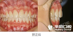 在濰坊華貝口腔做了牙齒矯正，恢復(fù)后我擺脫了齙牙妹