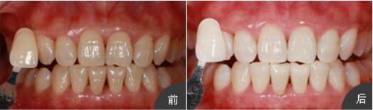 長沙半島口腔楊俊為我做的牙齒美白，讓牙齒輕松變白