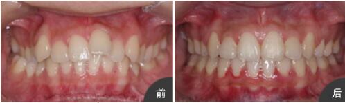 長沙半島口腔張瓊為我做的牙齒矯正，一年后牙齒就變整齊