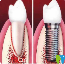 石家莊樂昂口腔種植牙宣傳圖