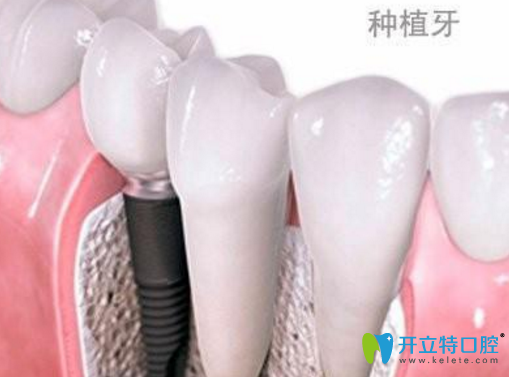 牙齒缺失影響健康 榆林長虹口腔德國Bego種植牙還你整齊牙齒