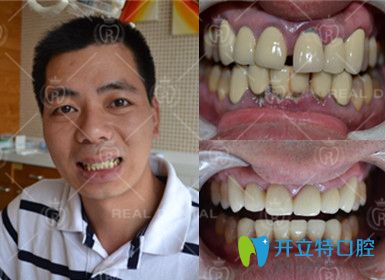 3D全瓷牙冠修復(fù)前后