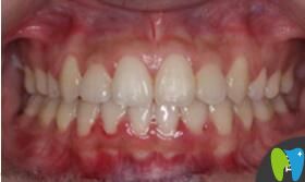 <!--<i data=20240703-sp></i>-->口腔張瓊牙齒矯正真人案例術(shù)后照