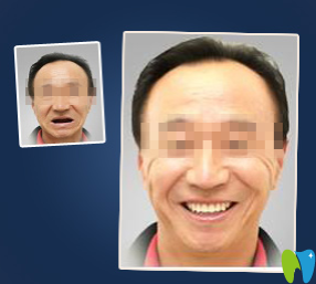 廈門(mén)宏沅膛口腔種植牙前后效果對(duì)比圖