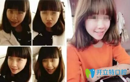 齙牙妹在康美口腔做牙齒矯正后