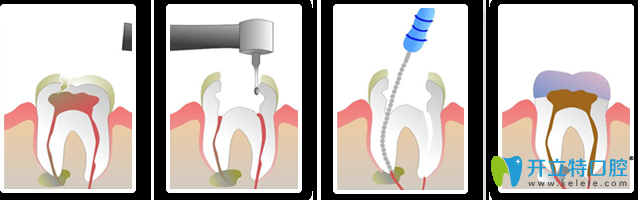 根管治療的過程