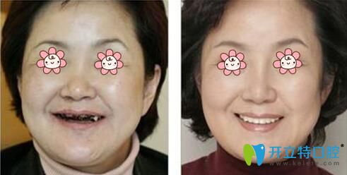 沈陽(yáng)康貝佳口腔“即刻用”種牙案例