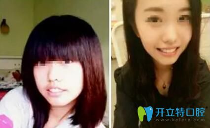 康美口腔牙齒矯正案例前后