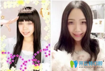 “齙牙妹”在欽州康美口腔做了牙齒矯正變身氣質(zhì)美女