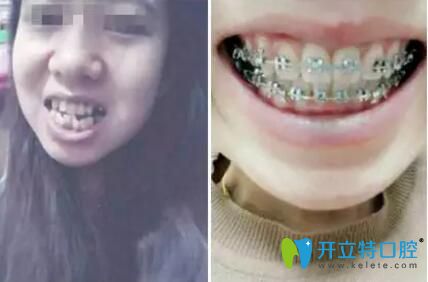 顧客在康美口腔做牙齒矯正