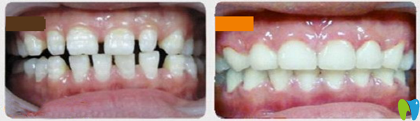 牙列稀疏前后對比
