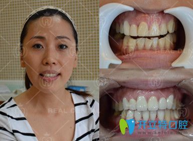 3D全瓷牙冠修復(fù)真人案例