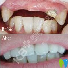 王宏洲多顆牙種植案例